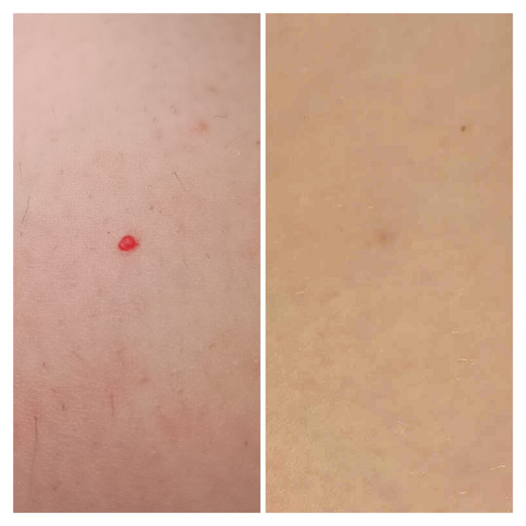 Zamykanie Naczynek  Znamion Rubinowych Bydgoszcz 08